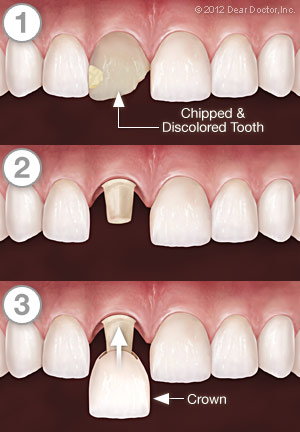 Series implementing crowns by Dentist Near me Bolingbrook IL