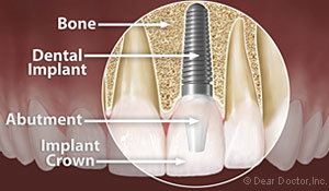Anatomy Dental Implants Bolingbrook IL