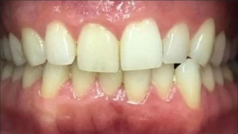 Teeth Whitening Bolingbrook IL