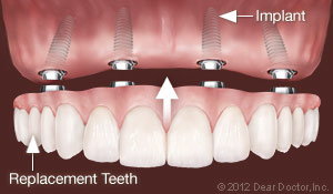 Replace one tooth with Dental Implants Infinite Smiles