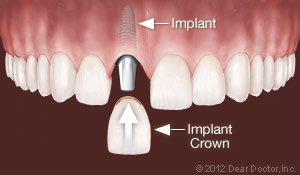 Replace one tooth with Dental Implants Bolingbrook IL