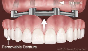 Dental Implants support Dentures Bolingbrook IL