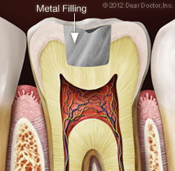 Metal Dental Fillings Bolingbrook IL