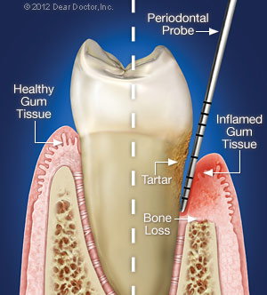 Cure Periodontal disease with Dentist Near me Bolingbrook IL
