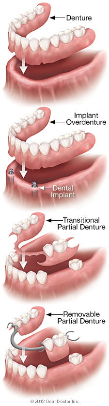 Types Removable Dentures Bolingbrook IL