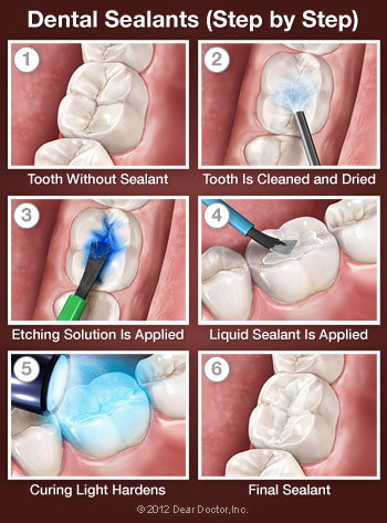 Step by step procedure for Sealants Bolingbrook IL