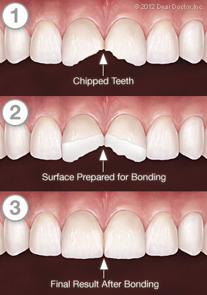 Dental Bonding series Bolingbrook IL by Infinite Smiles