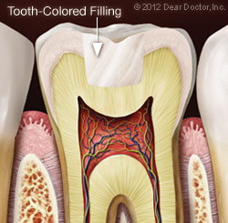 Tooth Colored Dental Fillings Bolingbrook IL