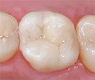 Dental Fillings which are Tooth Colored at Bolingbrook IL