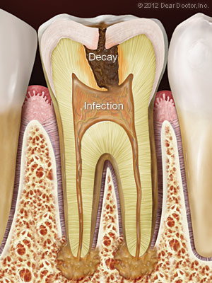 Tooth Decay infection before Root Canal Treatment Bolingbrook IL